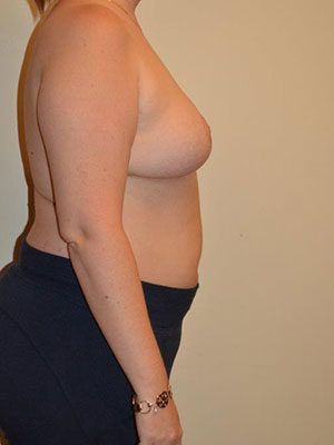 Breast Lift Case 14340 After Photo Breast Lift