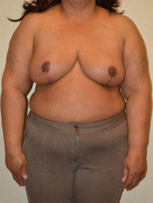 Breast Reduction Case 14318 After Photo Breast Reduction