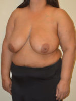 Breast Reduction