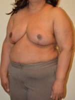 Breast Reduction