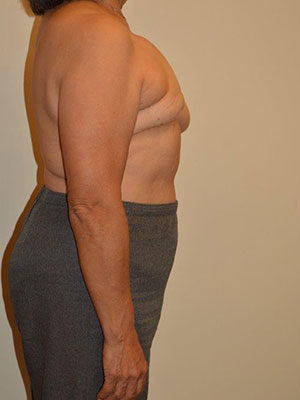 Breast Reconstruction Case 14333 Before Photo Breast Reconstruction