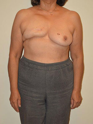 Breast Reconstruction Case 14333 Before Photo Breast Reconstruction