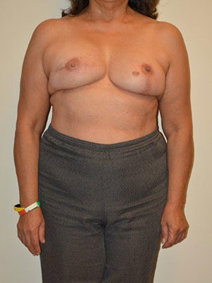 Breast Reconstruction Case 14333 After Photo Breast Reconstruction