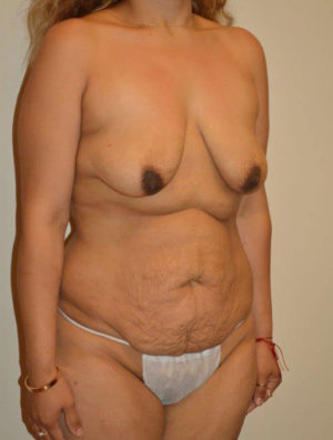 Liposuction Case 14431 Before Photo Liposuction