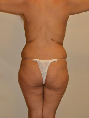 Liposuction Case 14431 Before Photo Liposuction