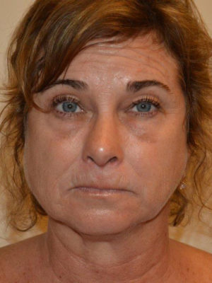 Nose Surgery Case 14364 After Photo Nose Surgery