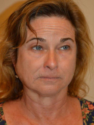 Nose Surgery Case 14364 Before Photo Nose Surgery