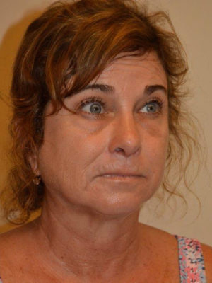 Nose Surgery Case 14364 After Photo Nose Surgery