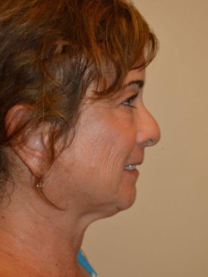 Nose Surgery Case 14364 Before Photo Nose Surgery