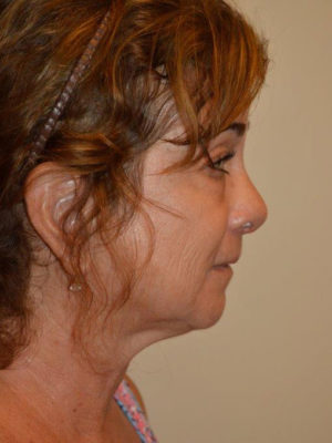 Nose Surgery Case 14364 After Photo Nose Surgery