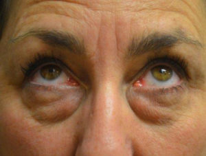 Eyelid Surgery Case 14386 Before Photo Eyelid Surgery