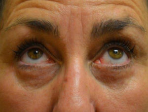 Eyelid Surgery Case 14386 After Photo Eyelid Surgery