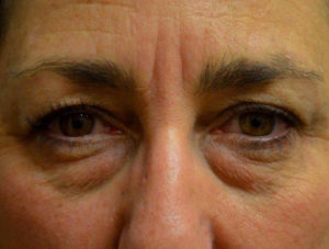 Eyelid Surgery Case 14386 Before Photo Eyelid Surgery