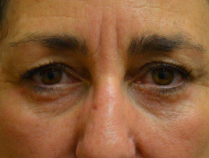 Eyelid Surgery Case 14386 After Photo Eyelid Surgery