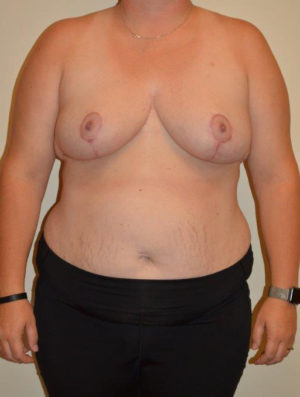 Breast Reduction Case 14379 After Photo Breast Reduction