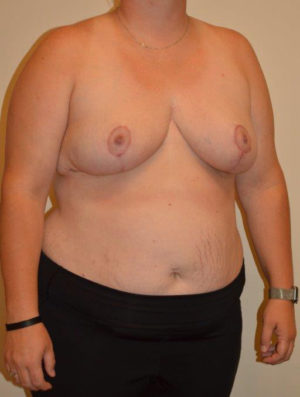 Breast Reduction Case 14379 After Photo Breast Reduction