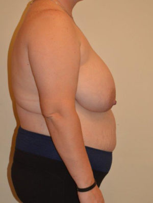 Breast Reduction Case 14379 Before Photo Breast Reduction