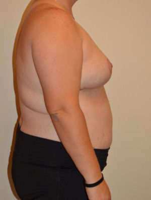 Breast Reduction Case 14379 After Photo Breast Reduction