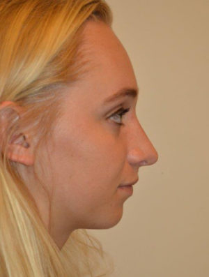 Nose Surgery