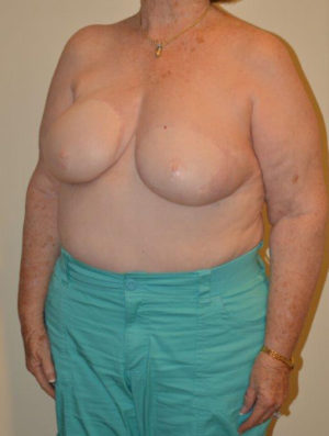 Breast Reconstruction Case 14372 Before Photo Breast Reconstruction