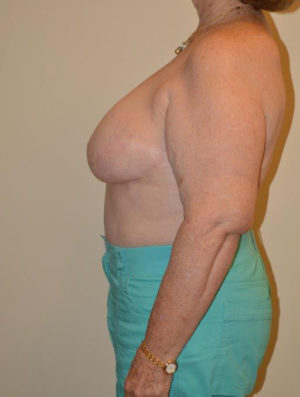 Breast Reconstruction Case 14372 Before Photo Breast Reconstruction