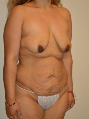 Breast Augmentation with Lift Case 14416 Before Photo Breast Augmentation with Lift