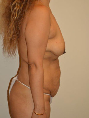 Breast Augmentation with Lift Case 14416 Before Photo Breast Augmentation with Lift