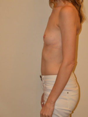 Breast Augmentation Case 14395 Before Photo Breast Augmentation