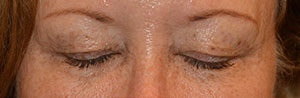 Eyelid Surgery Case 14462 Before Photo Eyelid Surgery