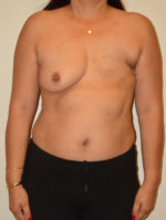 Breast Reconstruction