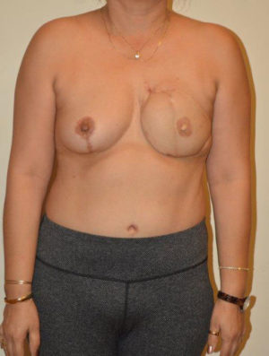 Breast Reconstruction Case 14479 After Photo Breast Reconstruction