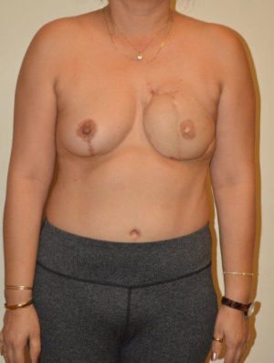 Breast Reconstruction