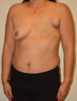 Breast Reconstruction Case 14479 Before Photo Breast Reconstruction