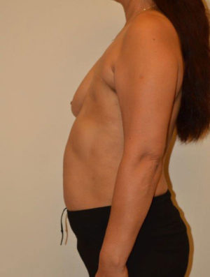 Breast Reconstruction Case 14479 Before Photo Breast Reconstruction