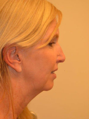 Nose Surgery Case 14484 Before Photo Nose Surgery