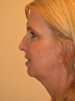 Nose Surgery Case 14484 Before Photo Nose Surgery