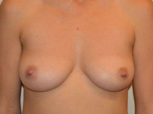 Inverted Nipple Repair Case 14493 After Photo Inverted Nipple Repair