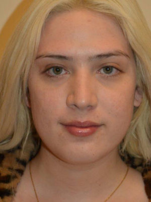 Nose Surgery Case 14496 After Photo Nose Surgery