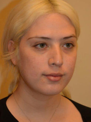 Nose Surgery Case 14496 Before Photo Nose Surgery