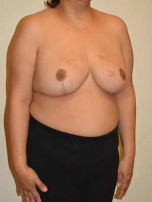 Breast Reduction Case 14503 After Photo Breast Reduction