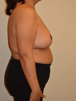 Breast Reduction Case 14503 After Photo Breast Reduction