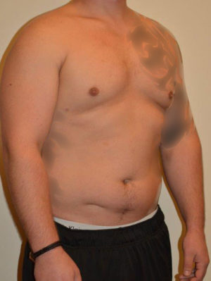 Gynecomastia Case 14517 After Photo Gynecomastia