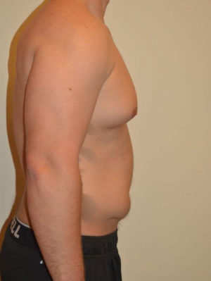 Gynecomastia Case 14517 Before Photo Gynecomastia