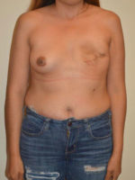 Breast Reconstruction