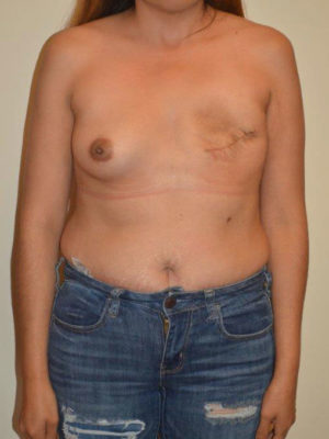 Breast Reconstruction Case 14524 Before Photo Breast Reconstruction