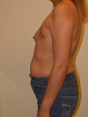 Breast Reconstruction Case 14524 Before Photo Breast Reconstruction