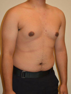 Gynecomastia Case 14535 Before Photo Gynecomastia