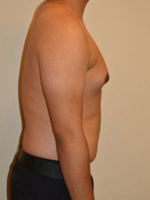 Gynecomastia