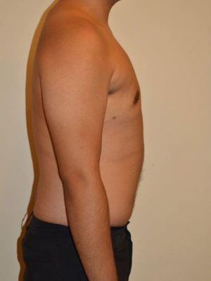 Gynecomastia Case 14535 After Photo Gynecomastia