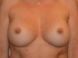 Inverted Nipple Repair Case 14542 After Photo Inverted Nipple Repair